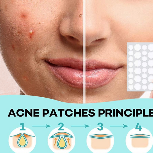 36 Pimple Patch – Clear Skin Acne Spot Treatment